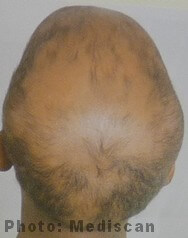 Steroid injection alopecia areata