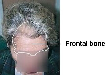 Receding Hairline? Receding Temples? Learn How and Why