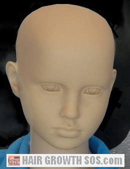 A young child with complete baldness from totalis or universalis has a very low chance of permanent recovery Alopecia totalis or universalis in a child