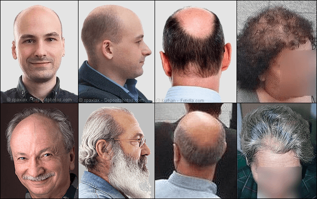 Male Pattern Baldness Genetics Explained