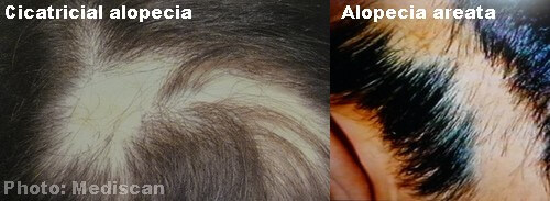 alopecia universalis vs alopecia areata alopecia universalis vs alopecia areata
