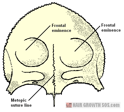 Frontal bone showing two frontal eminences