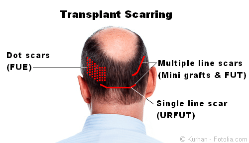 All hair transplant techniques can cause scarring Hair transplant scarring