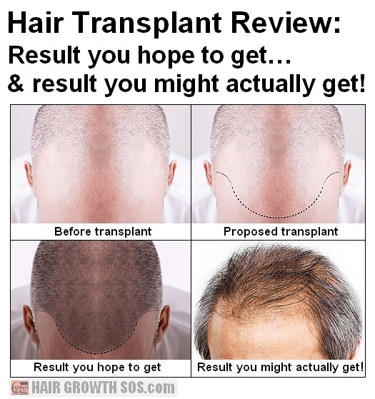 Hair transplant treatment