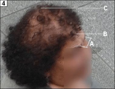 This lady has typical skull shape characteristics for hair loss development Lady with androgenetic alopecia