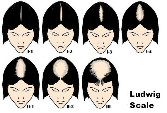Alopecia female diagram alopecia treatment diagram alopecia female diagram alopecia treatment diagram