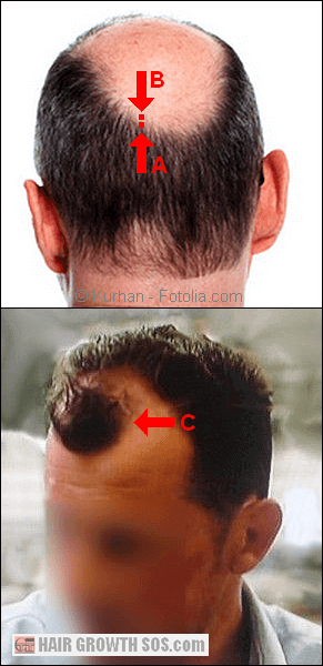 Problems in the male pattern baldness genetics theory highlighted