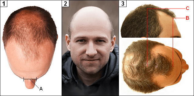 76  How can i regrow my frontal hairline for Oval Face