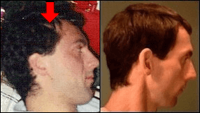 Photos showing my receding temples and how my hair growth recovered Paul Taylor before and after hair loss photos