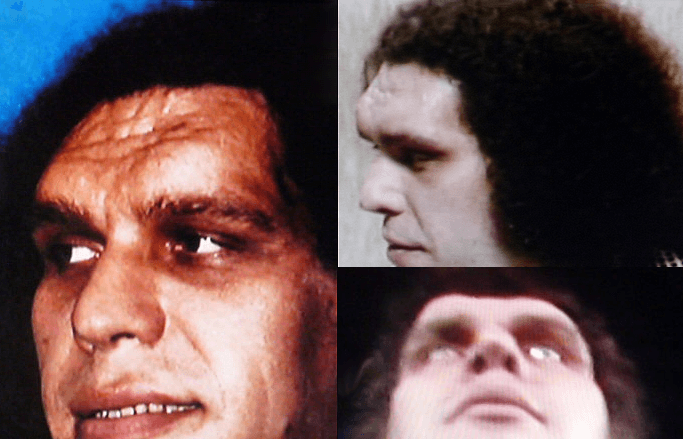 Protruding forehead symptom of acromegaly