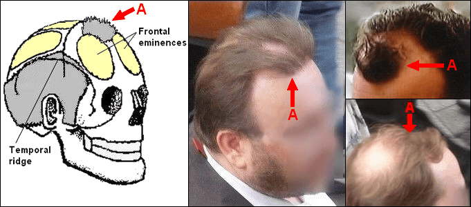 Why the Pattern in Male Pattern Baldness Develops Why the Pattern in Male Pattern Baldness Develops