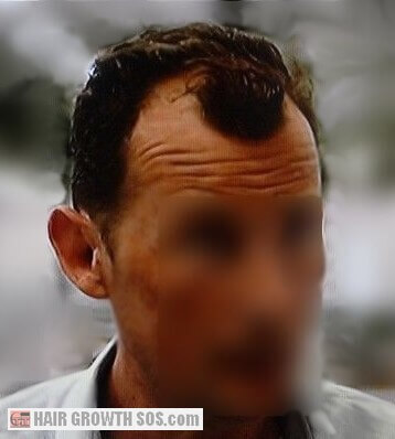 Strong scalp hair growth at position of maximum curvature