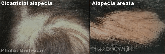 Scarring alopecia and alopecia areata symptoms can easily be confused with each other Scarring cicatricial alopecia and alopecia areata
