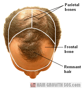 Strong signs of balding