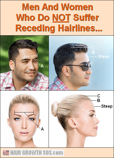 Hairline girl receding 16 Year