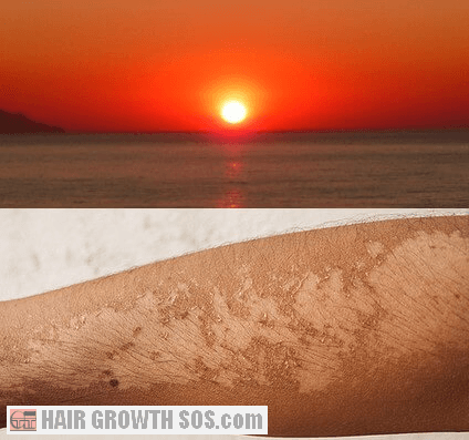 A strong sun can cause skin damage and skin peeling A strong sun can cause skin damage and skin peeling