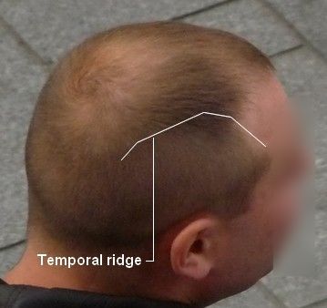 Why the Pattern in Male Pattern Baldness Develops