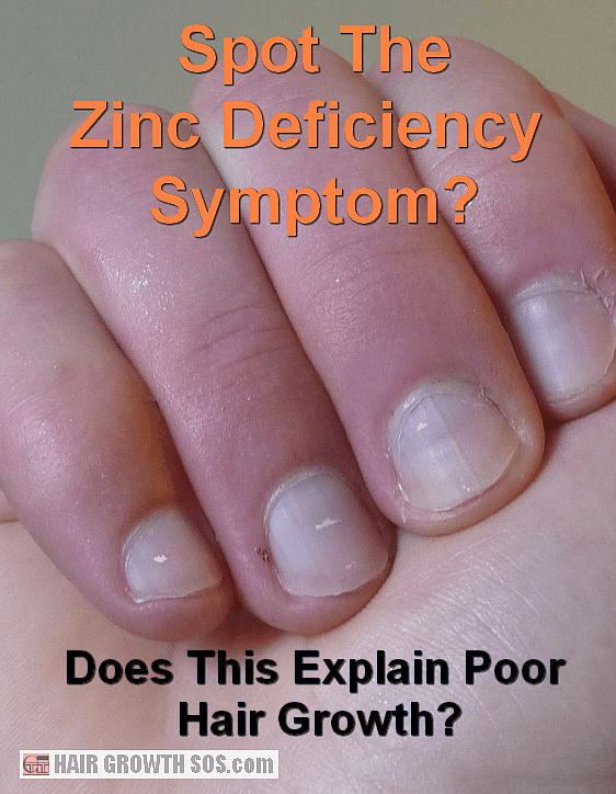 White marks on fingernails