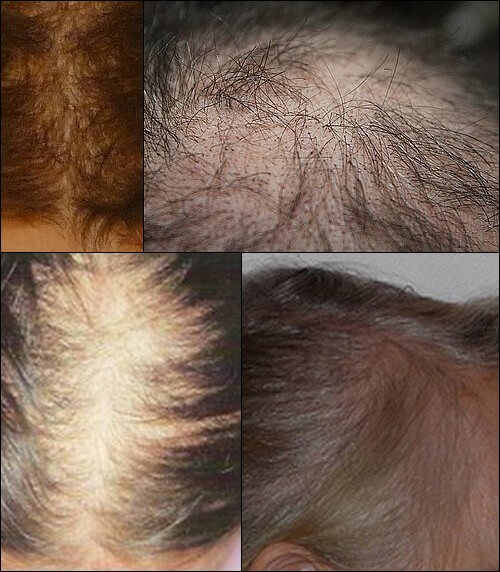 Telogen Effluvium Natural Treatment Telogen Effluvium Natural Treatment