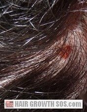rogaine effects side rash scalp follicle inflammation roots hair facts