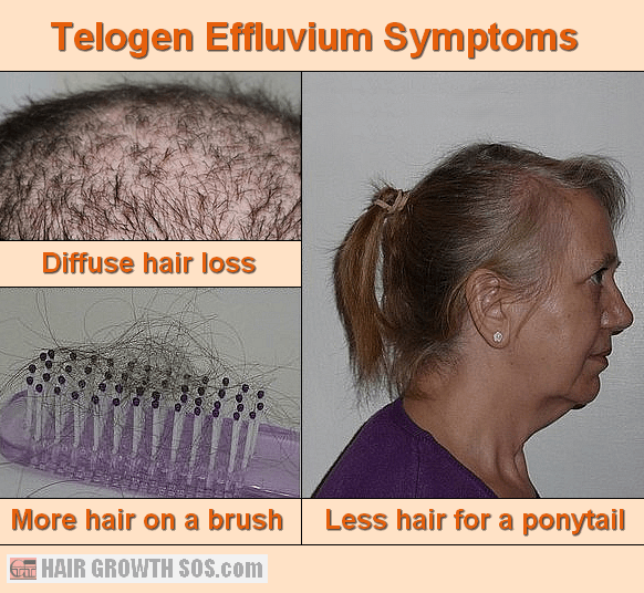 how to stop telogen effluvium how to stop telogen effluvium